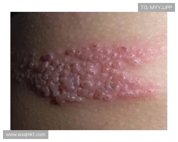 哈利伯顿带状疱疹折磨发福 哈利伯顿带状疱疹折磨发福